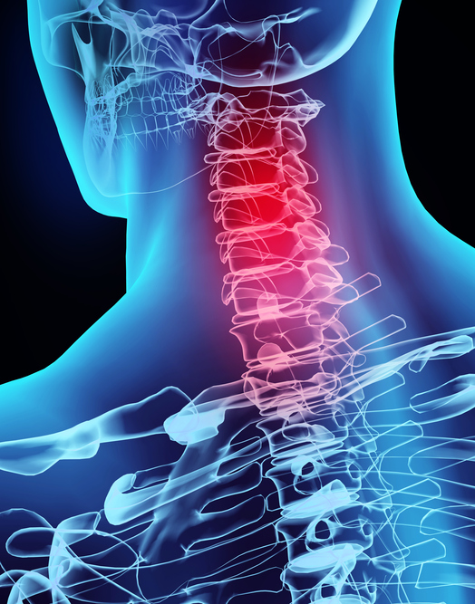 Illustration of an x-ray image of a neck injury with a red glow to show where the spinal injury occurred. 