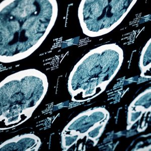 mri head scan brain injury